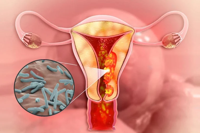 Genital Tuberculosis (TB) In Females: Awareness, Symptoms, And Treatment